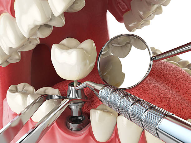 Best Emergency Root Canal Treatment in Middletown, VA
